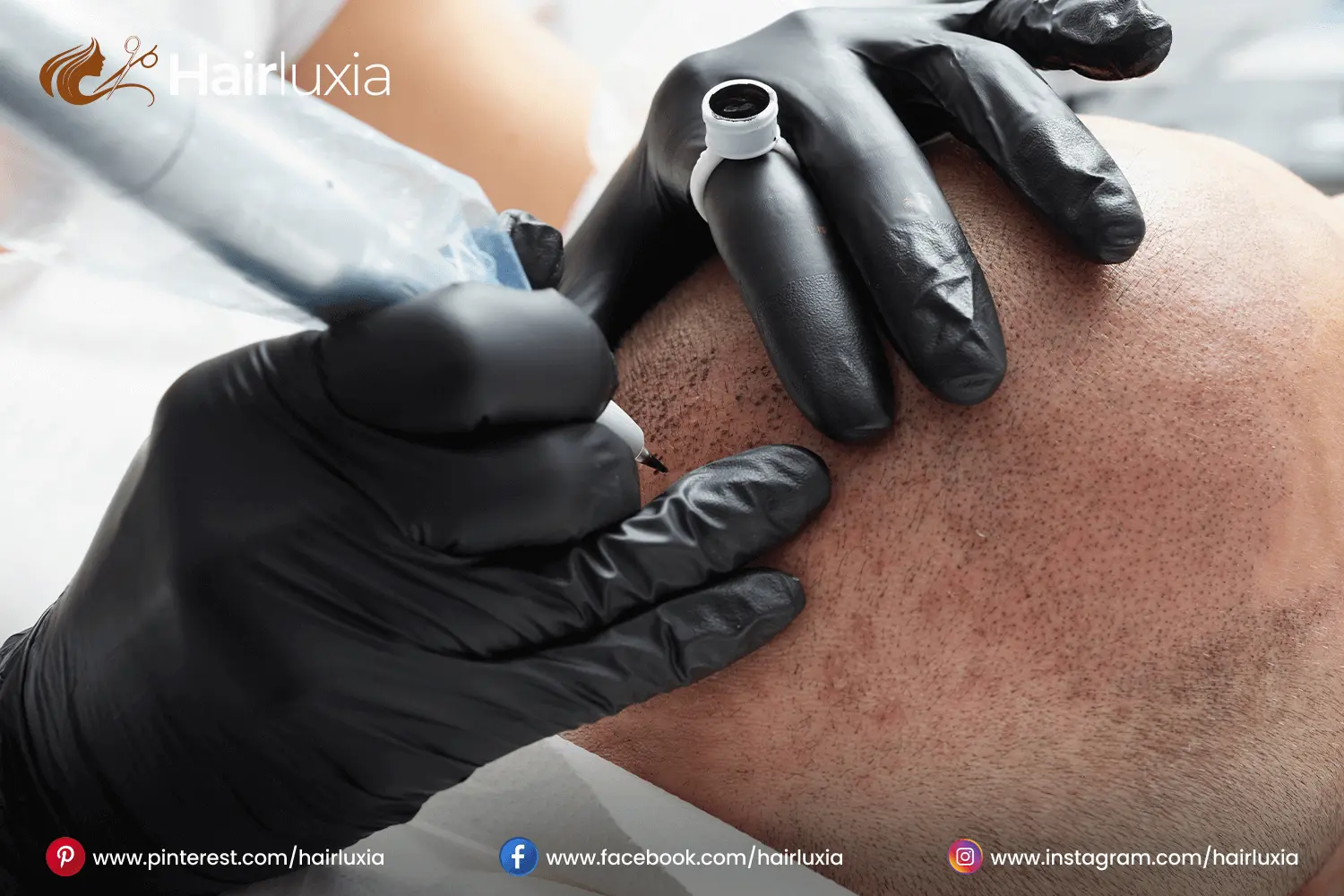 Direct Hair Implantation (DHI)