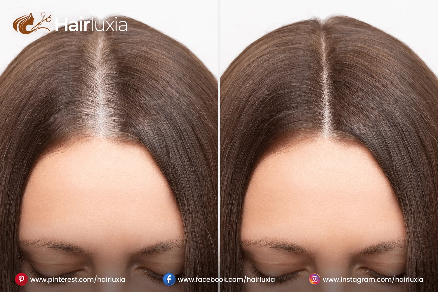  latanoprost for hair growth